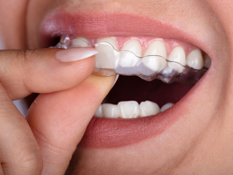 Clear Aligners